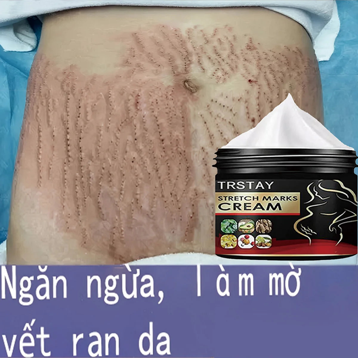 TRSTAY Stretch Mark Cream for Pregnancy Skin Replenish And Repair Cell Growth Promotion Maternity Striae Gravidarum Care